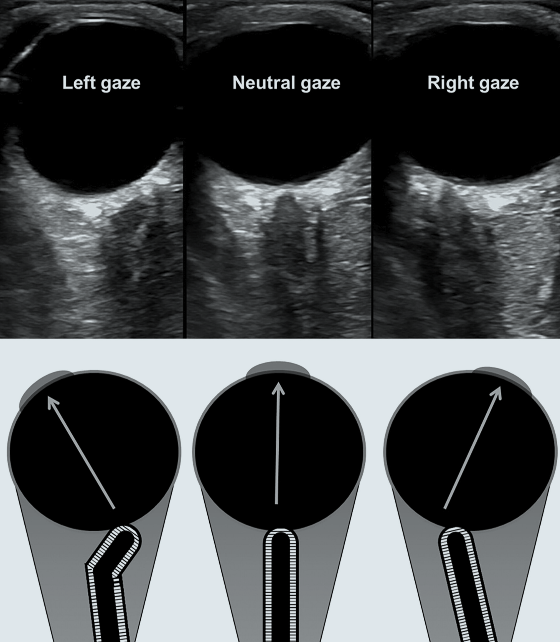 Ultrasonographic optic nerve sheath diameter technical pitfalls and imaging artifacts